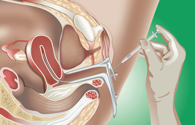 Inseminazione Intrauterina - centro infertilità puglia